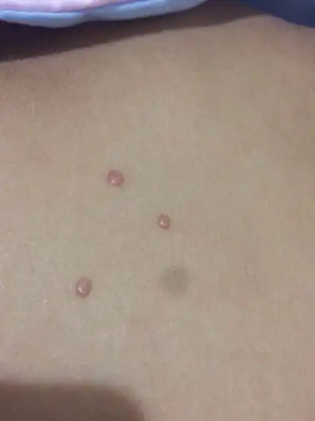 红疙瘩,以前一个,抠破了,就长了三个