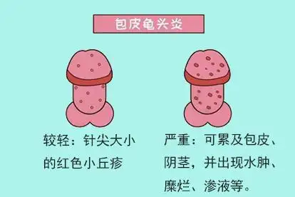 长期的包皮垢刺激容易导致细菌感染进而引发龟头炎