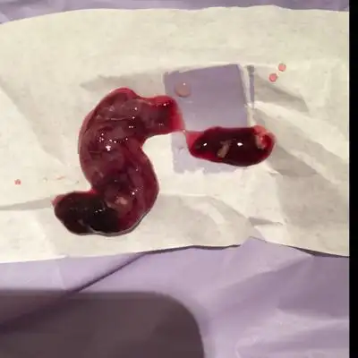 自然流产大家帮忙看看这是孕囊吗