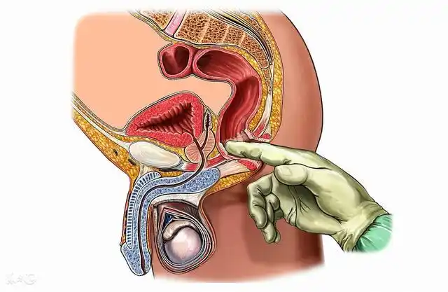 指检,当病人有便血,大便习惯改变都应做此项,此项可查出癌肿的部位