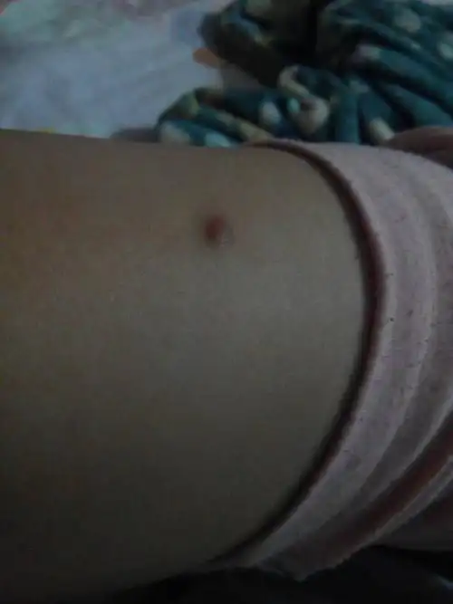 腿上长个小疙瘩有一年了吧,不疼不痒的,也没有长