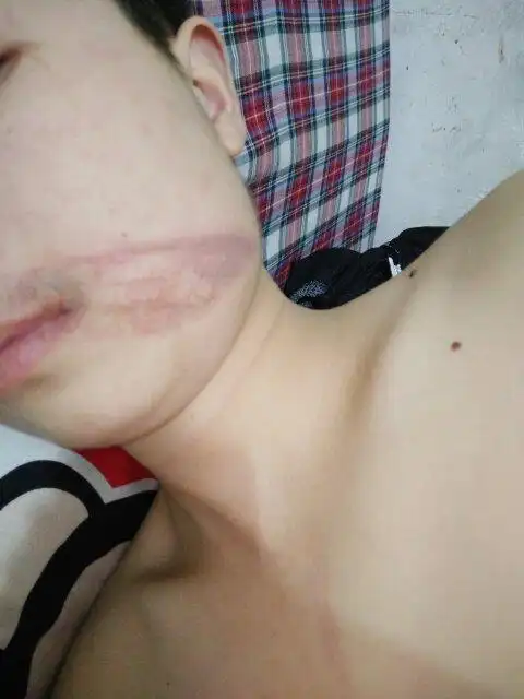 脸上被铝料烫伤怎么办 会不会有疤 得多久能长好,需要用药吗? 忌口吗?