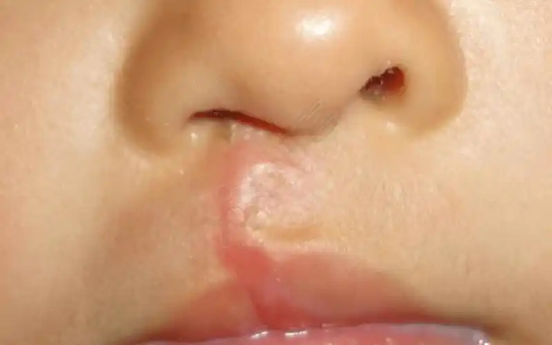 详解新生儿形成兔唇的5大原因快看看你中招没有