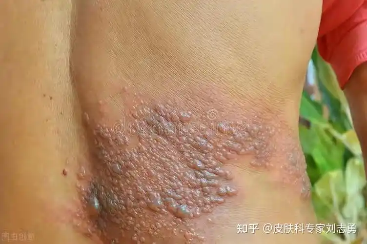 什么是"带状疱疹"?