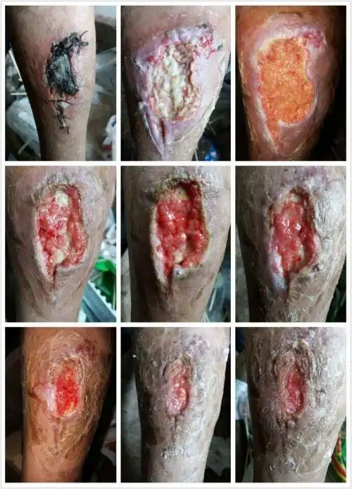 长肉芽就像这个样子