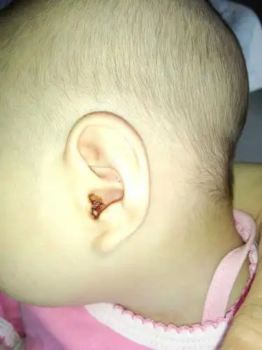 耳朵堵住了!着急现在在去医院的路上