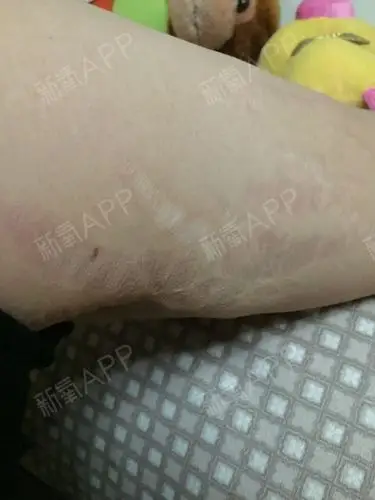 我因为吃过激素胳膊上被撑开了很多紫纹非常深做过一次_圈子-新氧美容