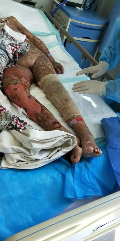 天疱疮合并感染患者的护理体会