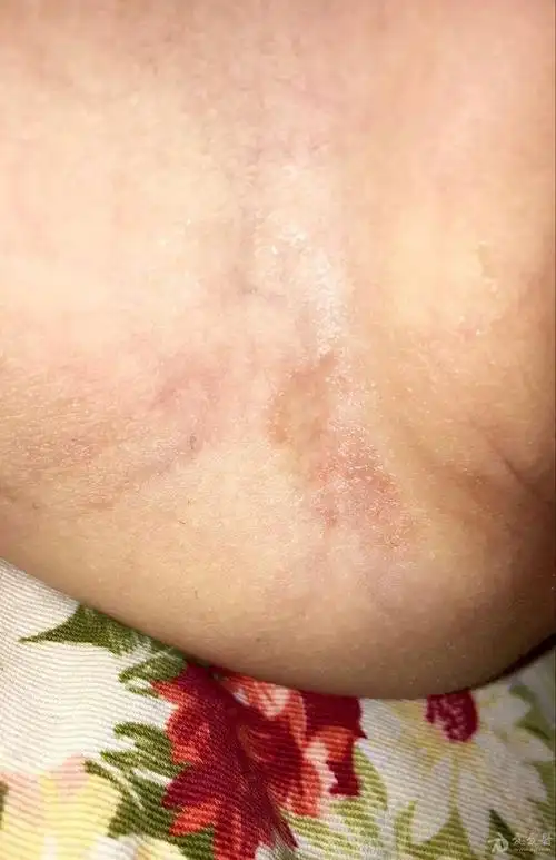 腹股沟皮损 - 皮肤及性传播疾病讨论版 - 爱爱医医学论坛