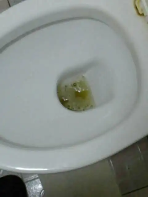 我撒尿有泡沫且久不散我认为自己有蛋白尿