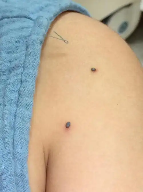 不能让一个蜱虫取命