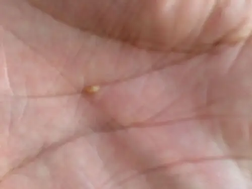 从脸上毛孔里挤出来的,这是什么啊?怎么治?怎么预防?