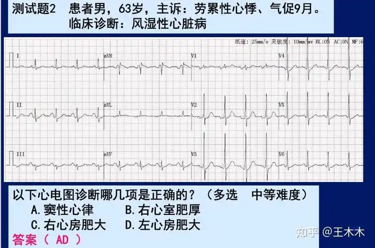 心电图-心房肥大,心室肥厚 - 知乎