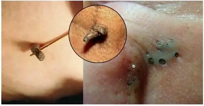 远离「黑头」绝不能挤,磨,挑!这样做才能快狠准的「正确根除」!