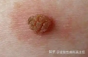 丝状疣反复发作怎么办