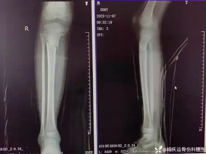 儿童胫腓骨近端骨折非手术治疗