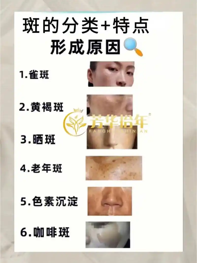 斑点类型科普|教你区分脸上的色斑6015.