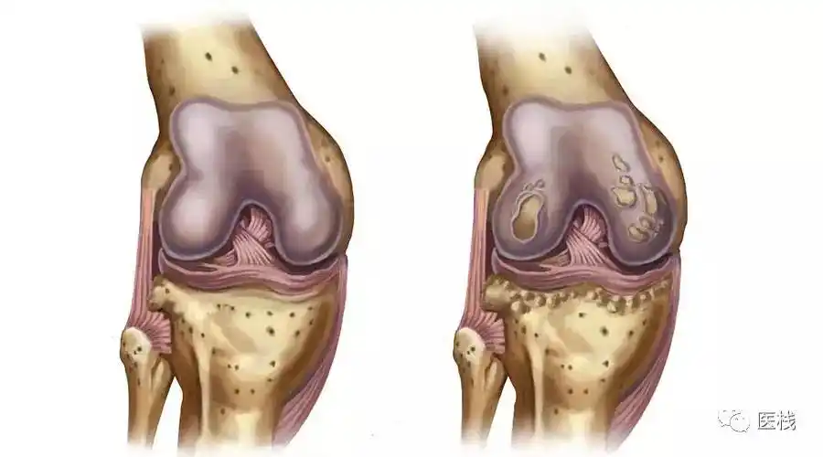 报告单上写着"骨质增生"就断定自己的症状是由增生的骨质(骨刺)引起的