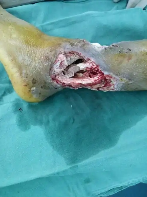 清创外固定架 vsd负压吸引技术治疗一例开放骨折后踝部严重感染老年