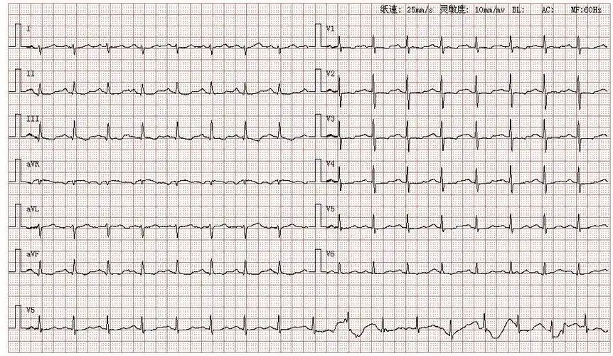 院,图为其心电图结论:窦性心律左后分支传导阻滞v1r/s>1st-t异常分析