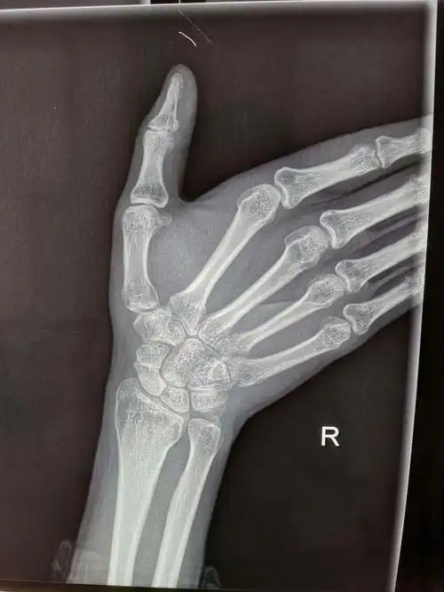 郑州市骨科医院会诊病例 腕舟骨骨折