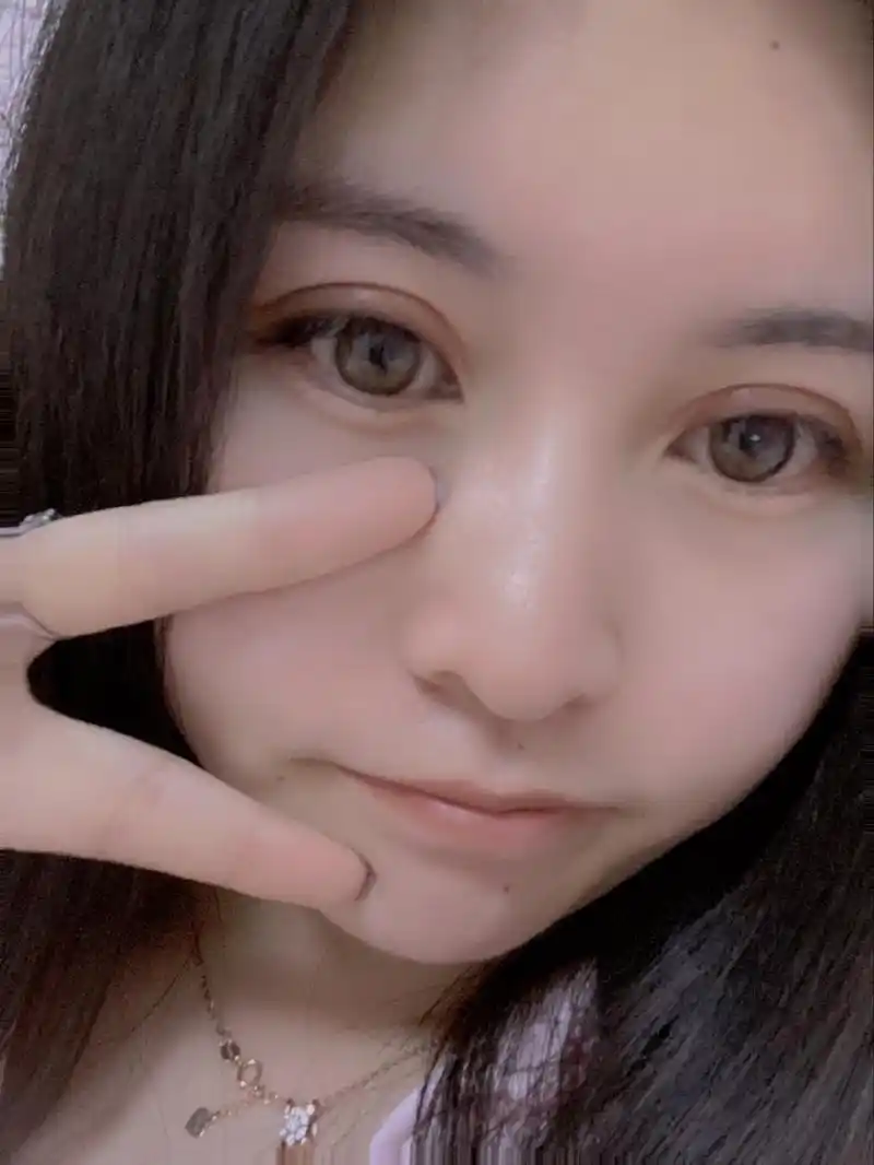 两个月20天的全切双眼皮