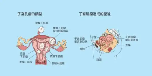 神猴二十五味鬼臼丸能否治疗子宫肌瘤