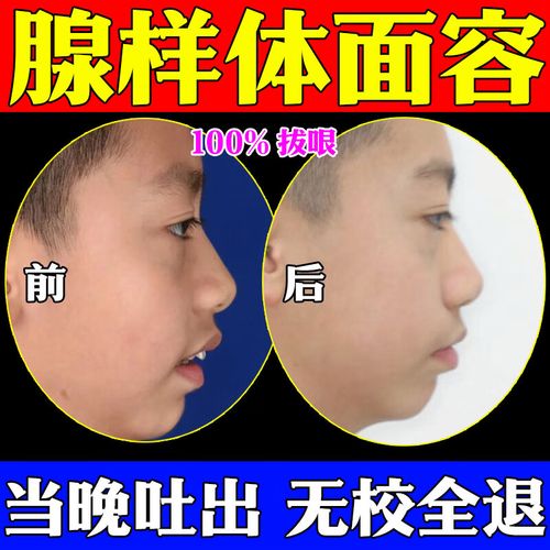 腺样体面容器 腺样体肥大中药贴儿童用药贴儿童张嘴呼吸s 1盒