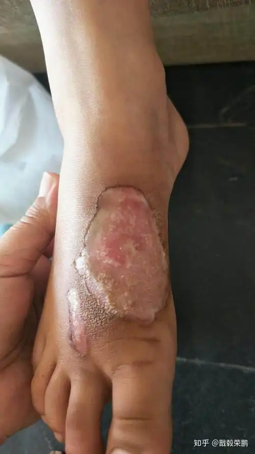 你见过的最好的治烧伤,烫伤的药是什么,有何效果? - 知乎