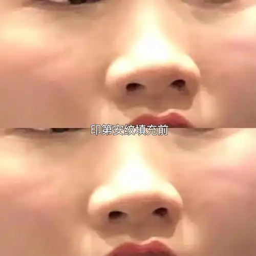 先天性遗传印第安纹