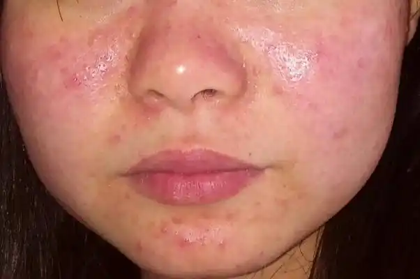 鼻子长螨虫症状图片 (9)