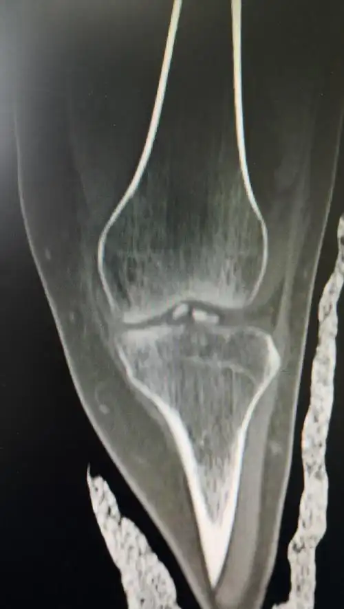 胫骨平台髁间脊骨折病例201811 - 好大夫在线