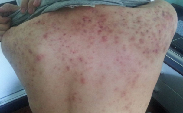 背上长痘痘有什么原因