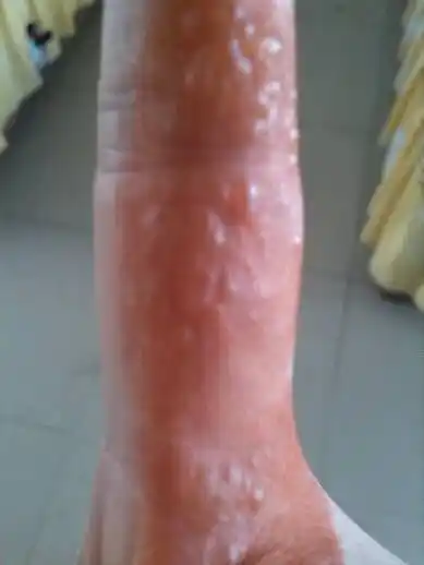 2014-03-31 李志勇 医师 阴囊上长很多痘痘 瘙痒 现在与偶时候抓的