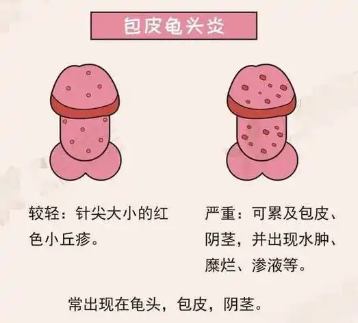 乌龟2024-01-0800阴茎红肿怎么回事 龟头炎多发生于包茎或包皮过长的