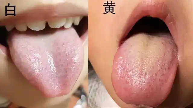 三招教会你看孩子舌苔