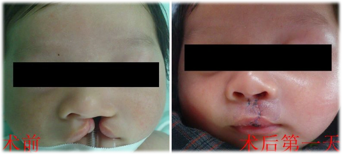 3度唇裂手术前后照片 - 好大夫在线