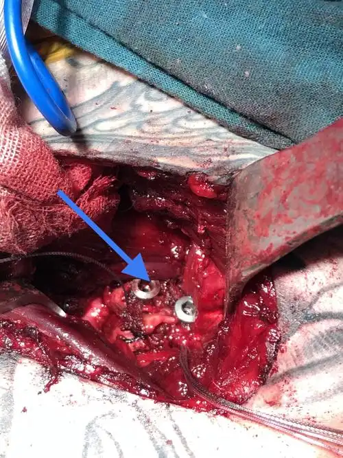 5空心钉固定喙突骨块,缝合骨块上保留的部分ca韧带与切开的关节囊缝合