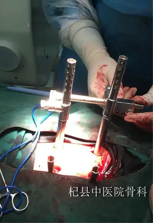 【杞县中医院骨科】经皮椎弓根钉棒内固定系统治疗胸腰椎骨折