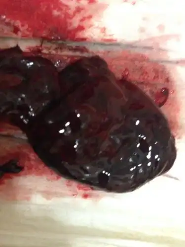 醇,这个是吃完米非司酮排出来的,想让大家帮看一下这个是胎囊还是血块