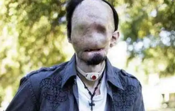 无脸症是什么世界上真的有没有脸的人吗