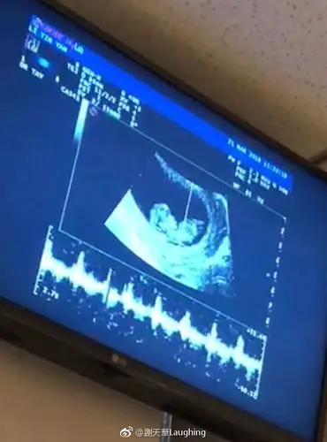 谢天华晒宝宝b超照 开心宣布老婆怀二胎