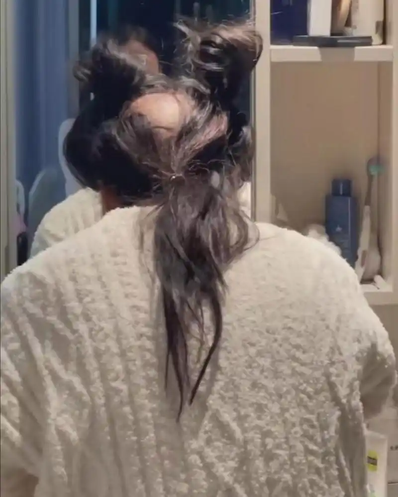 女生也会秃顶吗?无法理解