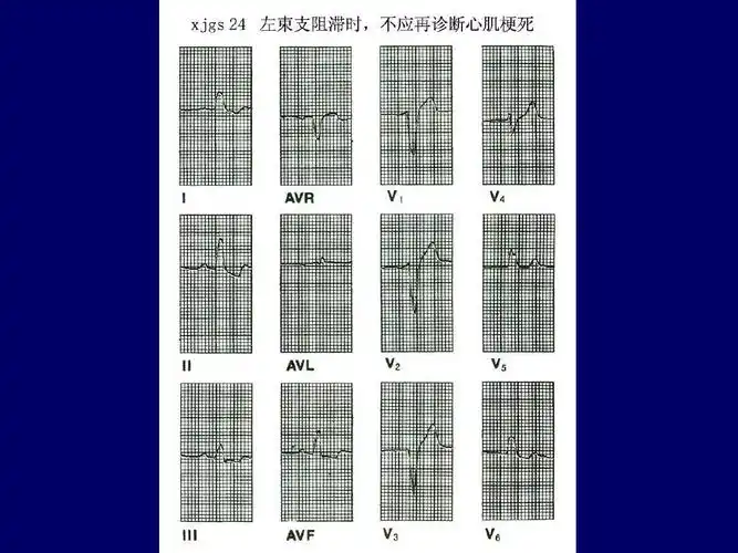 异常心电图图谱汇总ppt
