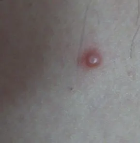 请大师们帮忙看下是不是ca复发?