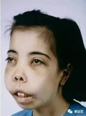 3 腺样体面容——上颌骨变长,硬腭高拱,上切牙突出,牙列不齐导致咬合