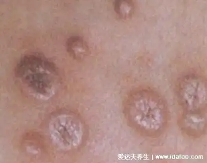 男性得性疾病后八大症状图片,警惕梅毒/生殖器疱疹/尖锐湿疣