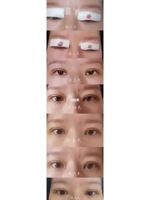 双眼皮七天恢复图来啦