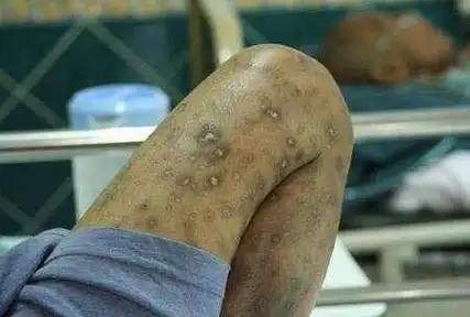 艾滋病最长能活多久