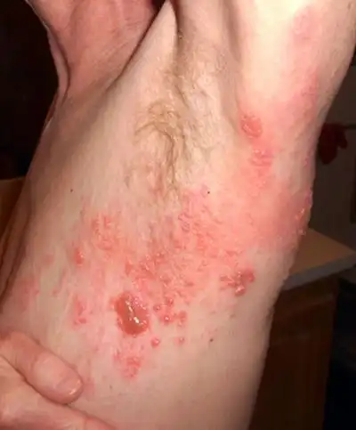 艾滋病的症状 (46)